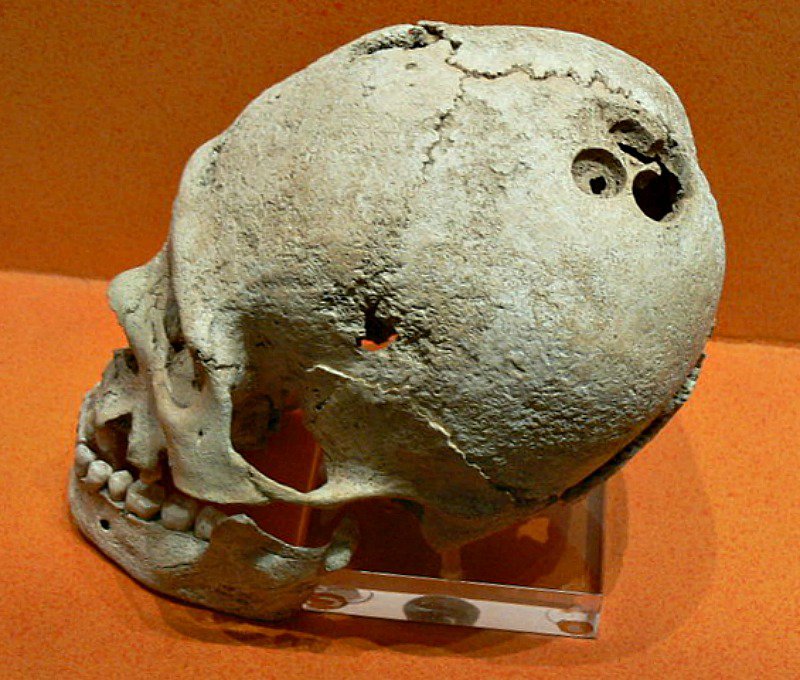 Trepanación craneal precolombina procedente del yacimiento arqueológico de Monte Albán, México. Museo de Sitio de la Zona Arqueológica de Monte Albán.