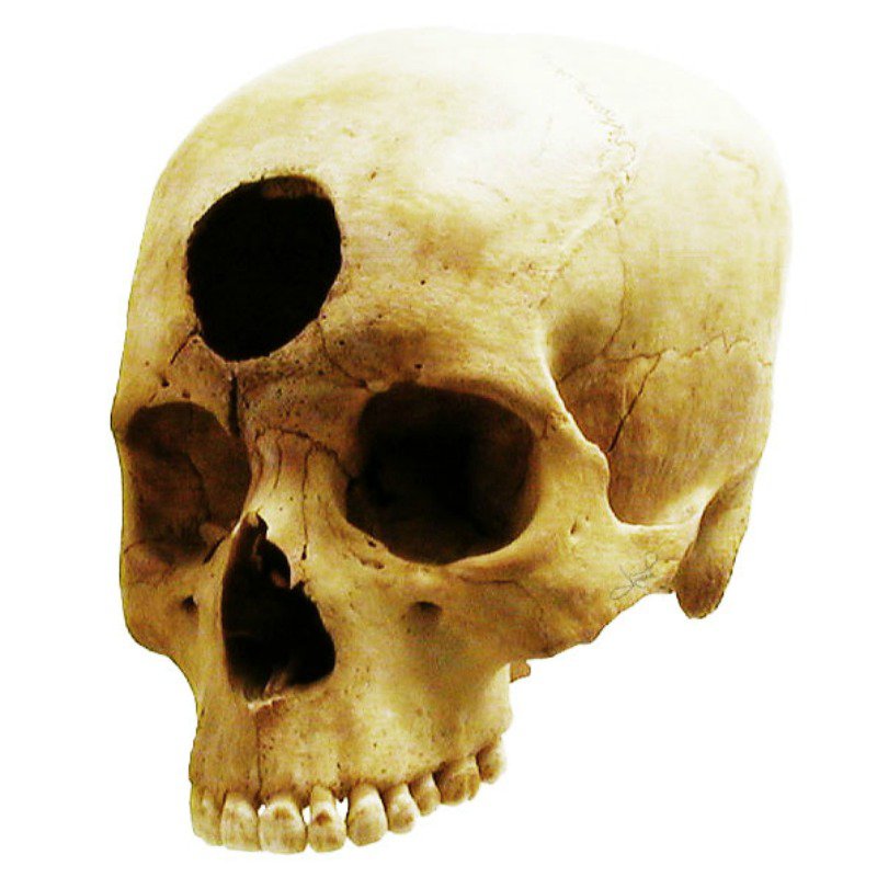 Cráneo perteneciente a la cultura Nazca, de hace alrededor de 2.000 años, que muestra una trepanación frontal, presumiblemente para tratar una inflamación.