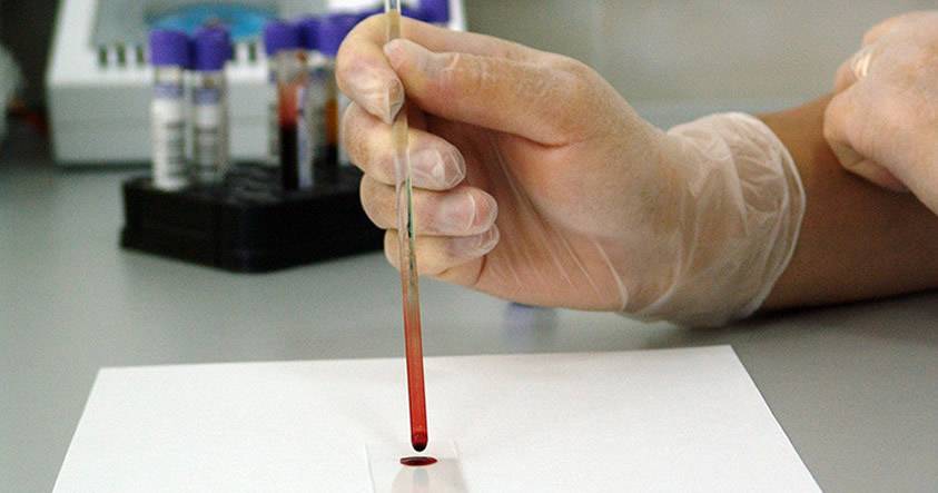 Un paciente británico de 44 años es declarado oficialmente curado del VIH