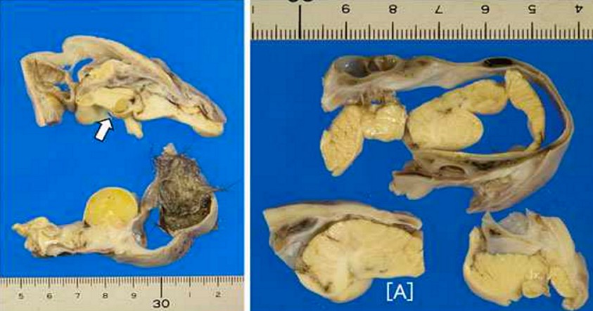 Extraen un diminuto cerebro, cráneo y cabello del ovario de una adolescente