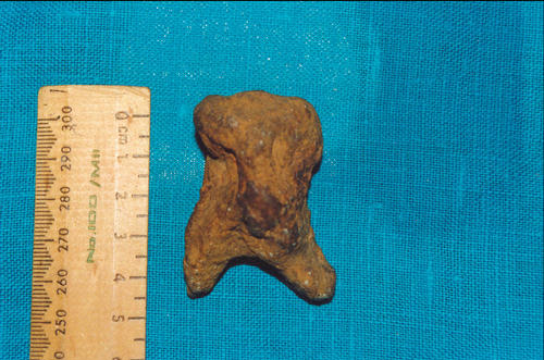 Enorme diente molar humano hallado por R. Gilroy