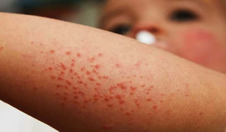 Mueren cientos de niños en un brote de sarampión en Madagascar Mueren cientos de niños en un brote de sarampión en Madagascar