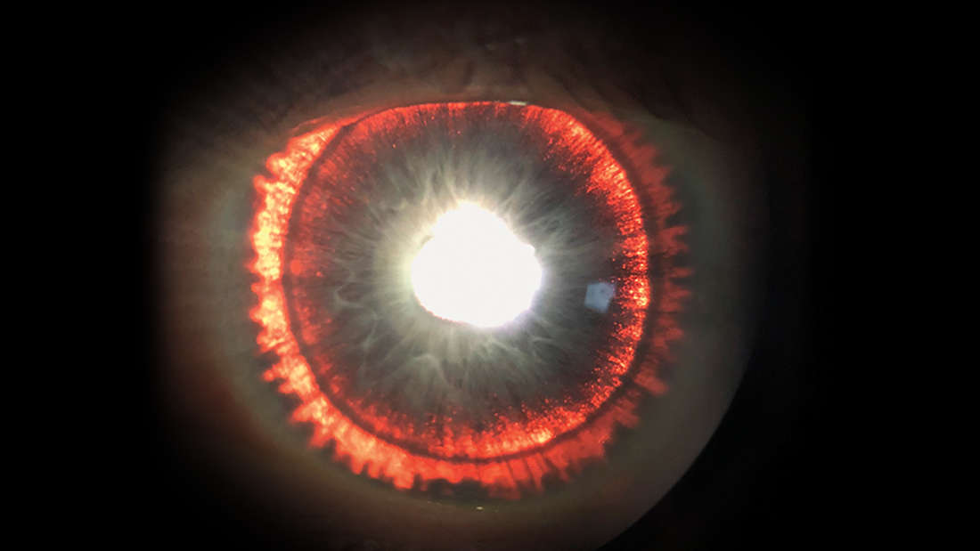 Examen ocular revela que iris en ojos de un hombre brillan intensamente