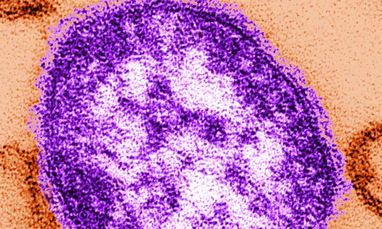 El sarampión afecta a más de 7 millones de personas al año y causa más de 100,000 muertes