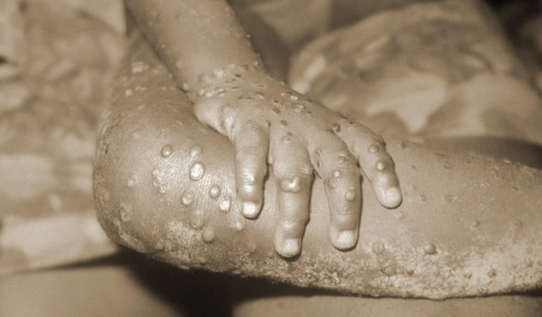 Confirman infección de un tipo raro de viruela en un paciente de Reino Unido Confirman infección de un tipo raro de viruela en un paciente de Reino Unido