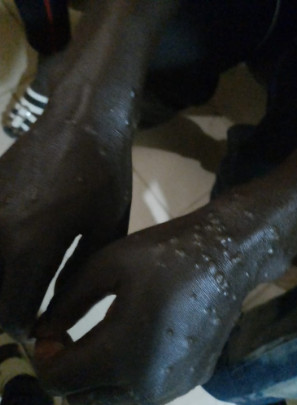 Enfermedad desconocida afecta a más de 500 personas en Senegal y obliga a aplicar cuarentena