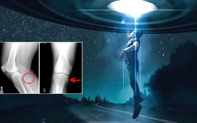 Testigo de “abducción” encuentra dos extraños implantes en su pierna (VIDEO)