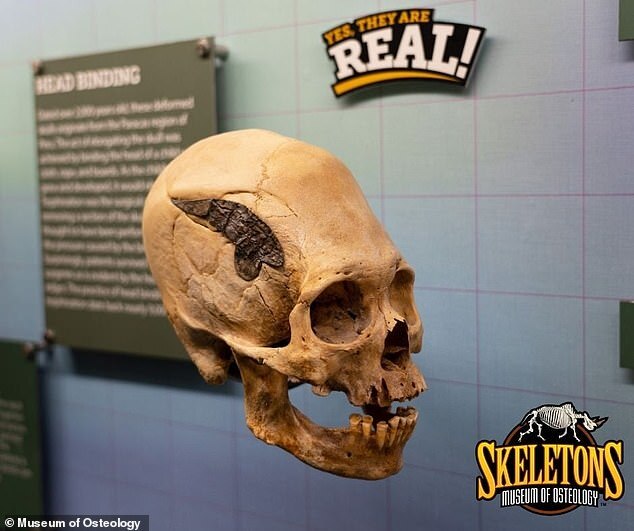 El cráneo alargado con un implante de metal exhibido en el museo