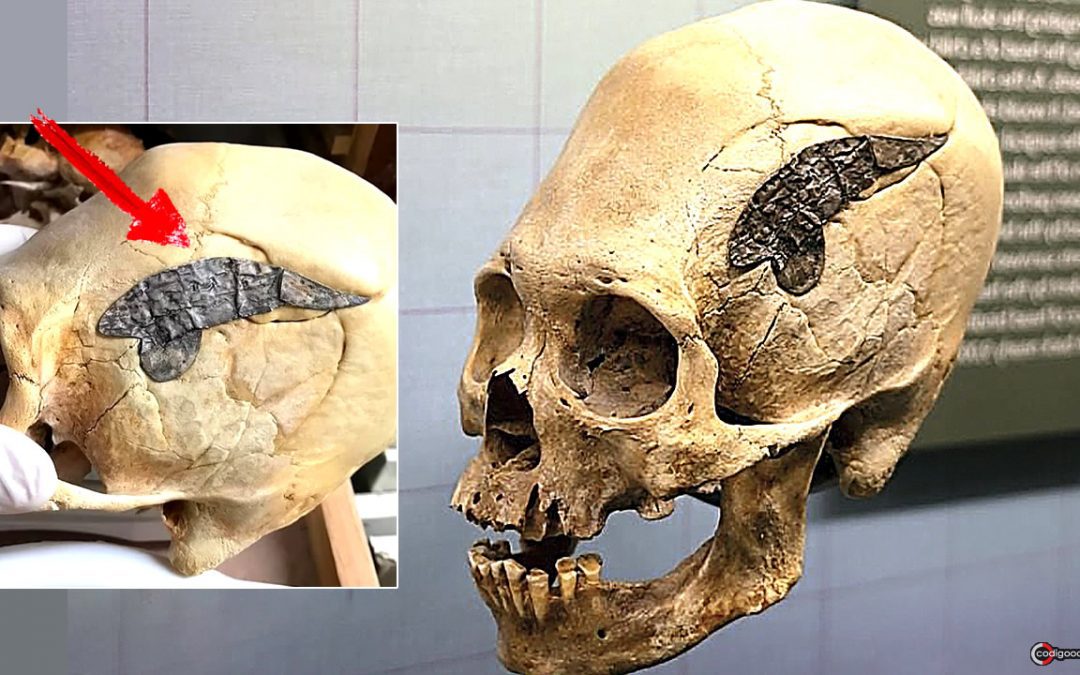 Exhiben cráneo alargado con placa de metal implantada. Guerrero de 2.000 años sobrevivió a la cirugía