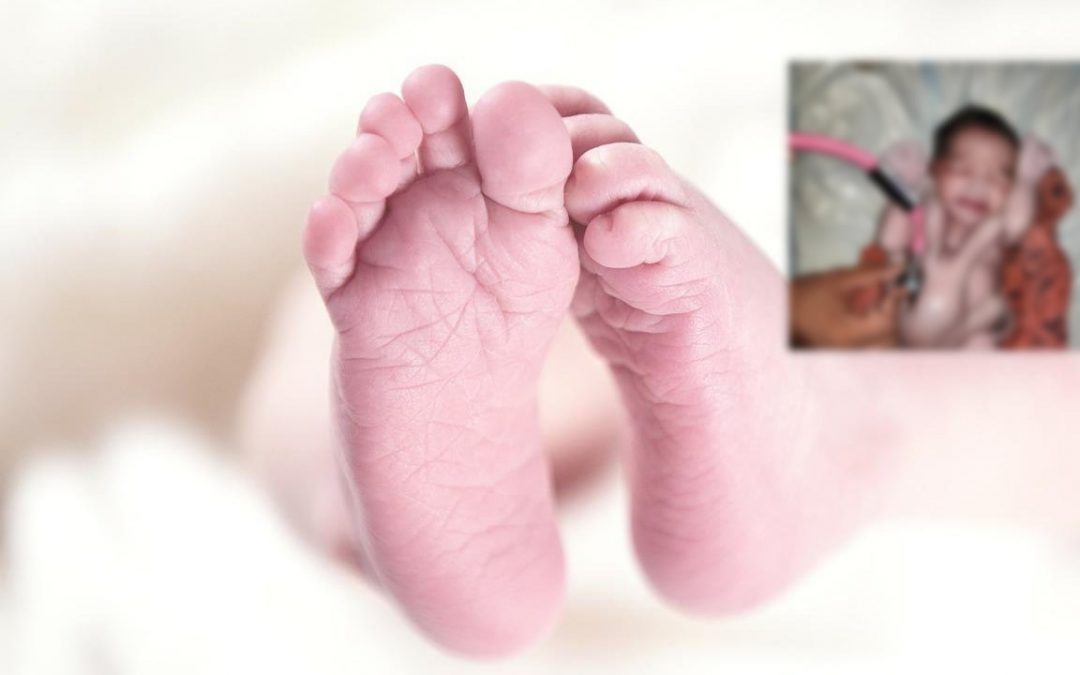 India: nace bebé con cuatro brazos y cuatro piernas. Es considerado “reencarnación de Dios”
