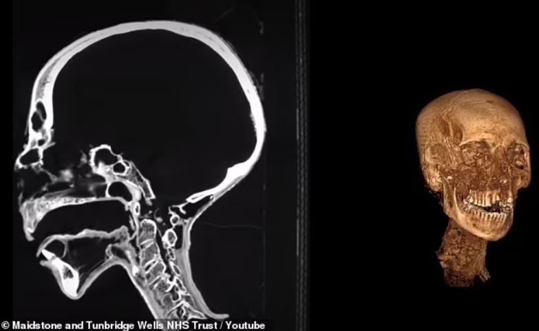 Se usó un escáner CT en la cabeza de la momia, lo que permitió al equipo recrearla en 3D y analizar lo que puede esconderse debajo de los envoltorios