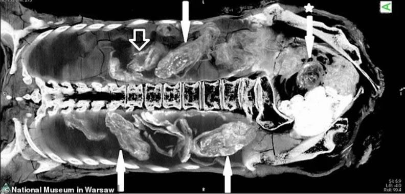 Algunos expertos del Mummy Project de Varsovia afirman que lo que parecía ser un feto en los escáneres de rayos X y las imágenes de tomografía computarizada era en realidad "una ilusión y una mala interpretación de la computadora". Dicen que algunos de los objetos representados aquí con flechas fueron identificados erróneamente como cabeza y cuerpo fetal