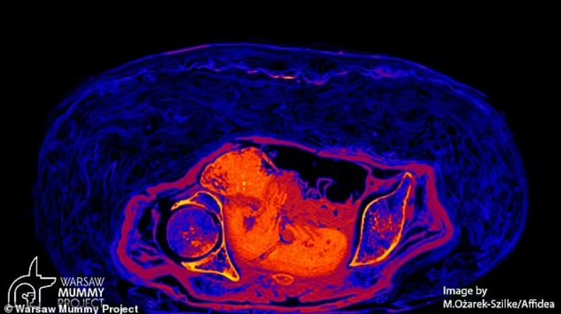 En 2021, a través de una combinación de tomografías computarizadas y rayos X, el Mummy Project de Varsovia afirmó haber descubierto los restos de un feto, de entre 26 y 30 semanas, dentro de la mujer.