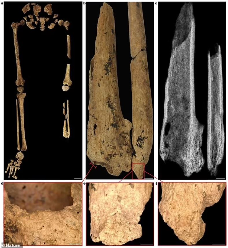 Los investigadores creen que los restos pertenecen a un individuo joven al que le amputaron quirúrgicamente el tercio inferior de la parte inferior de la pierna, probablemente cuando era niño