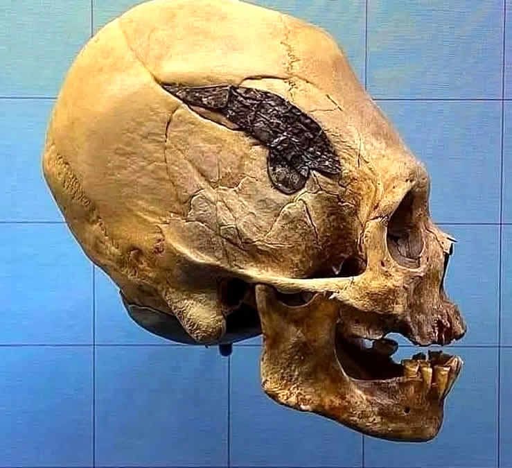 Cráneo de guerrero del antiguo Perú de 2.000 años de antigüedad con placa de metal implantada