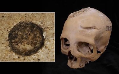 Cráneos de 4.000 años del antiguo Egipto muestran un “tratamiento contra el cáncer”