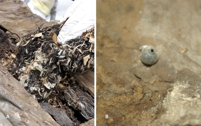 Izquierda: La extracción de partes del material extraño de la pared abdominal dorsal reveló una mezcla de tejido blanco fragmentado, pequeñas astillas de madera y material vegetal, junto con algunos residuos de tejido amorfo de color marrón. Derecha: La esfera extraña detectada en la pelvis izquierda tenía un pequeño orificio con un borde elevado.