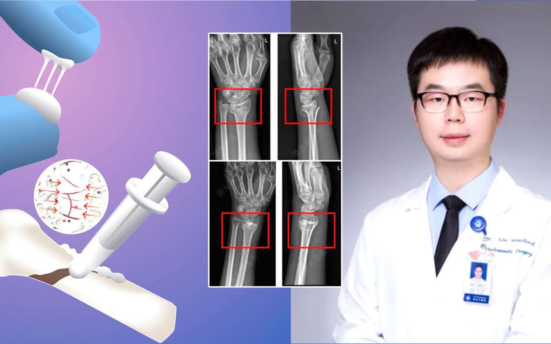 Científicos chinos crean un “pegamento óseo” que repara huesos rotos en tres minutos, e inspirado en las ostras